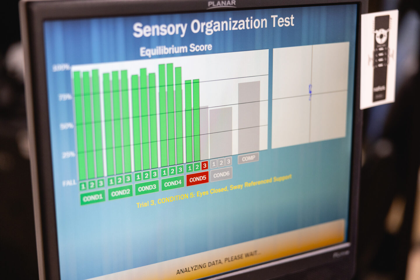 A monitor displays results from a Sensory Organization Test, showing equilibrium scores across various conditions as part of a baseline concussion evaluation. The data helps assess a patient